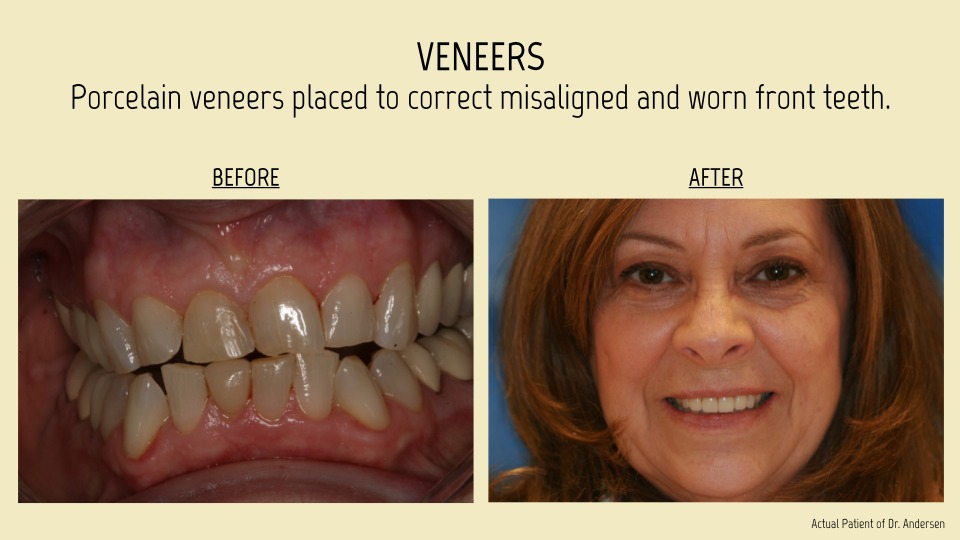 veneers patient