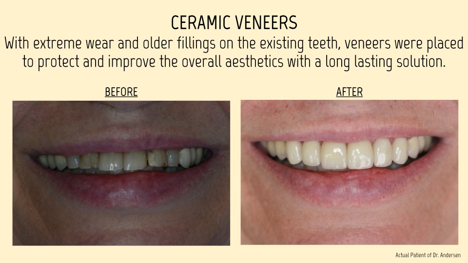 Ceramic Veneers