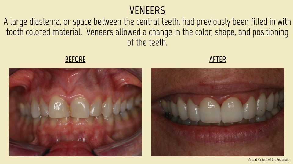 veneers patient