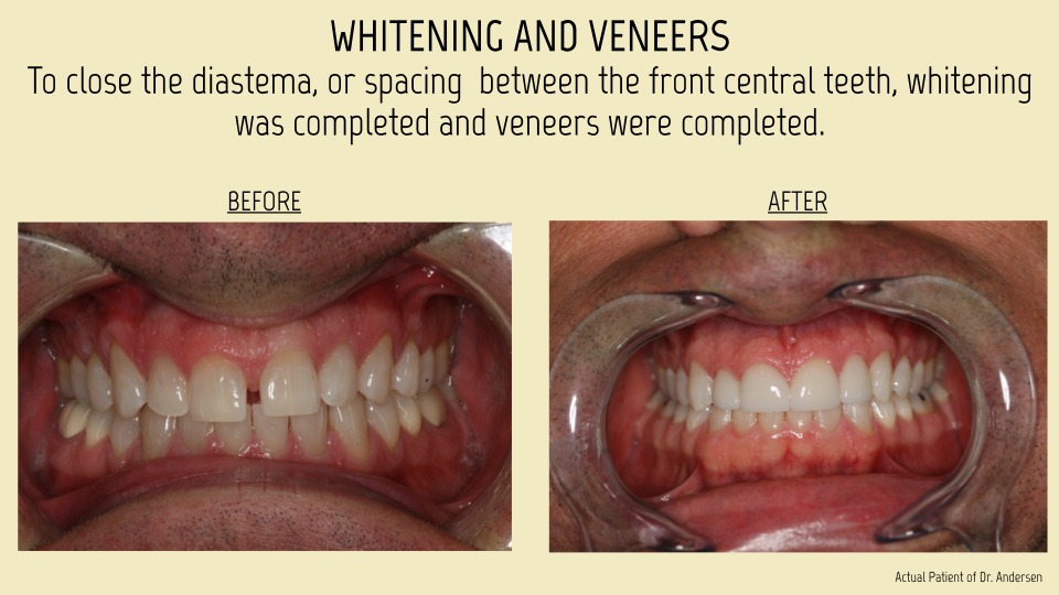 Whitening and Veneers