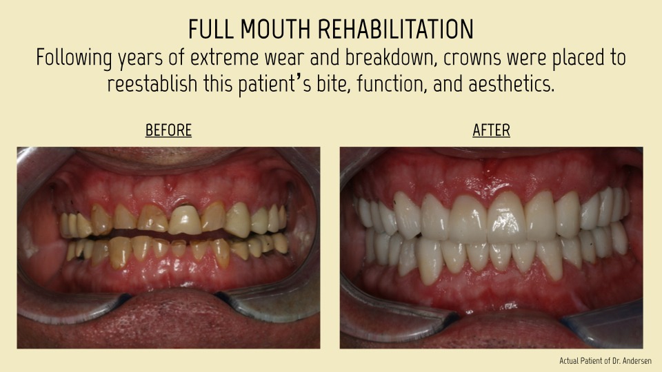 Full mouth rehabiliation