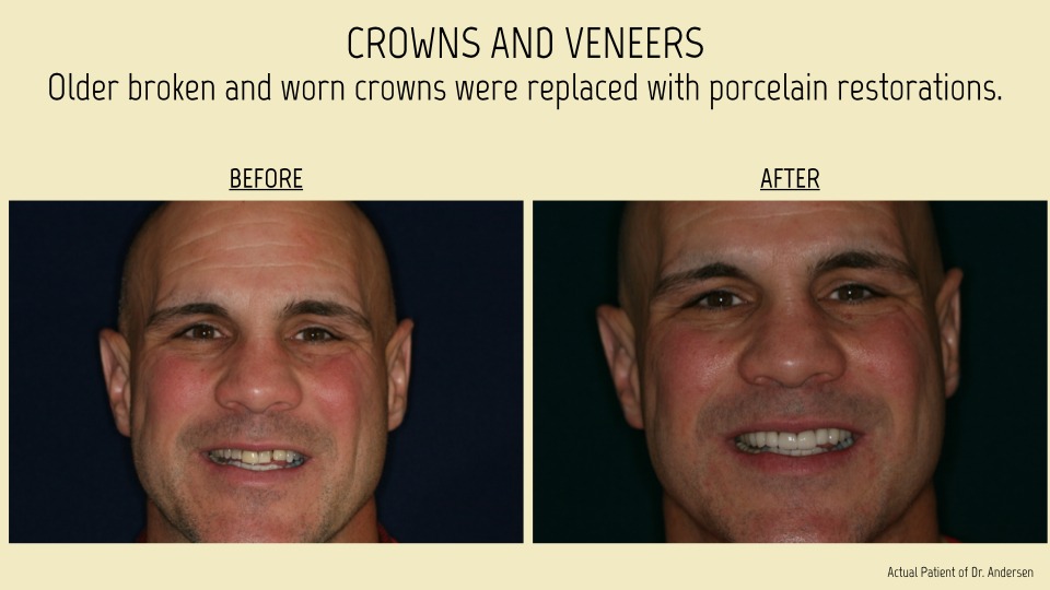 Crown and veneers patient