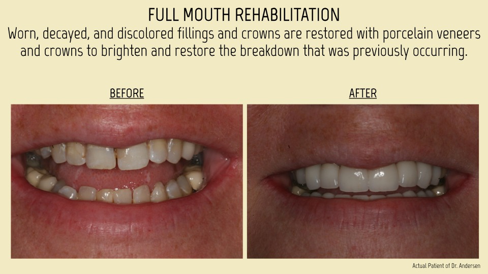 Full mouth rehabiliation