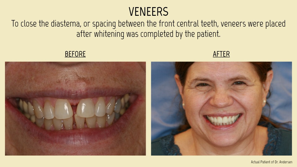 veneers patient