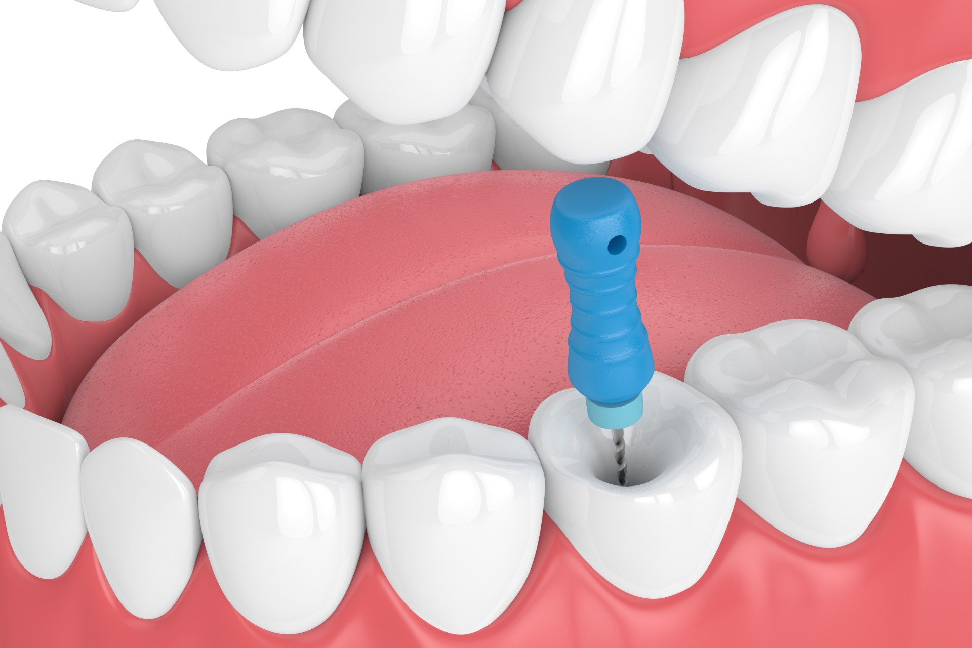 Root canal treatment concept