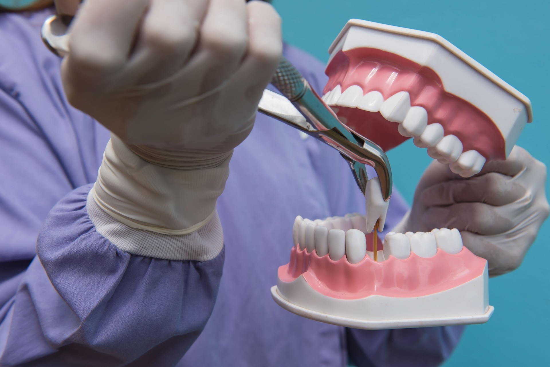 Tooth extraction by doctors